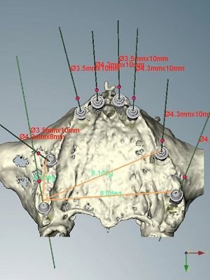 implantologia computer guidata