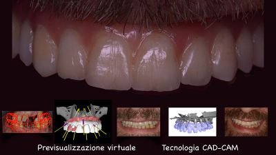 implantologia computer guidata