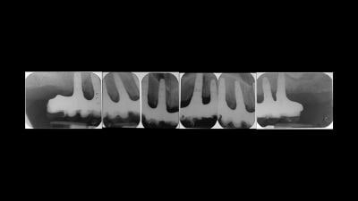 implantologia dentale