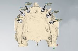 Implantologia computer guidata
