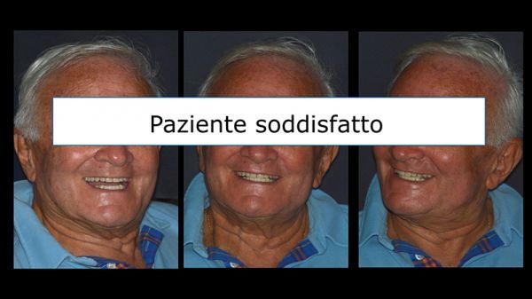 Implantologia computer guidata
