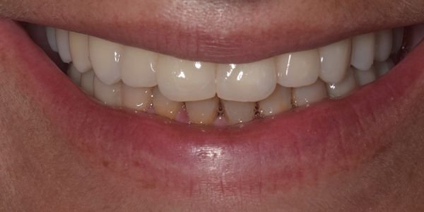impianti dentali