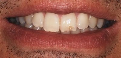 ricostruzioni dentali