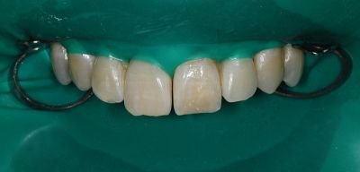 ricostruzioni dentali