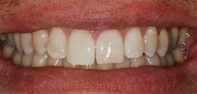 ricostruzioni dentali