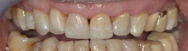 ricostruzioni dentali