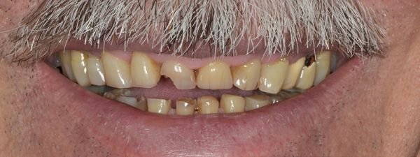ricostruzioni dentali