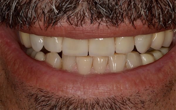 faccette dentali