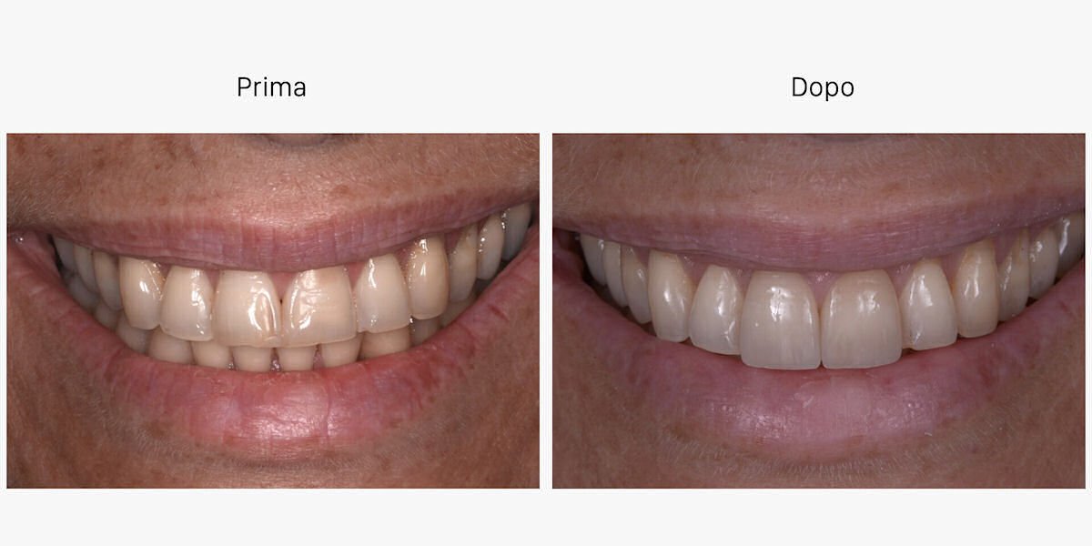 faccette dentali