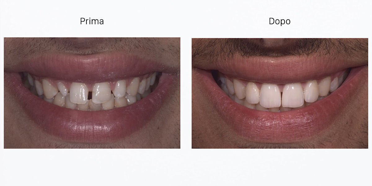 faccette dentali