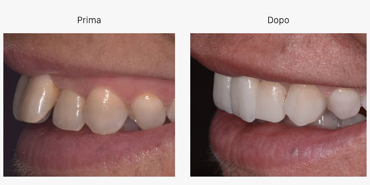 faccette dentali
