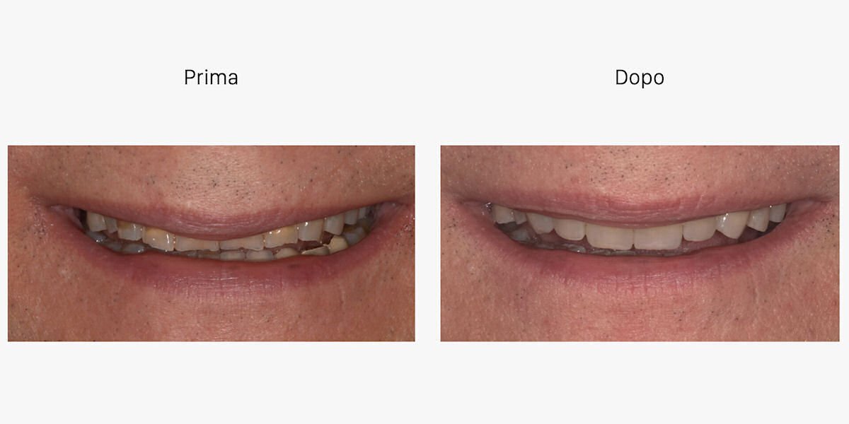 faccette dentali