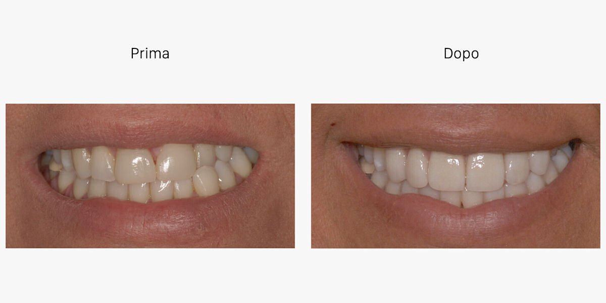faccette dentali