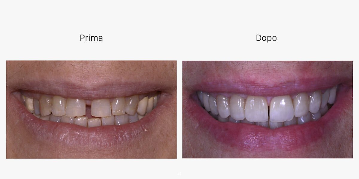 faccette dentali