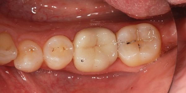 Corona in ceramica integrale (metal free)