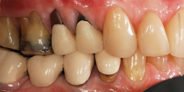 mal di denti