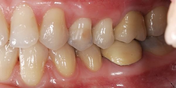 implantologia e cure gengivali