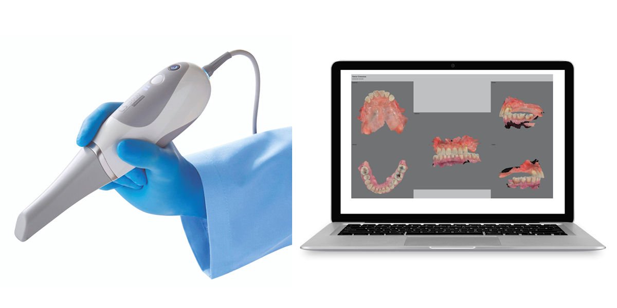 Scanner intraorale e ricostruzione digitale tridimensionale dei denti