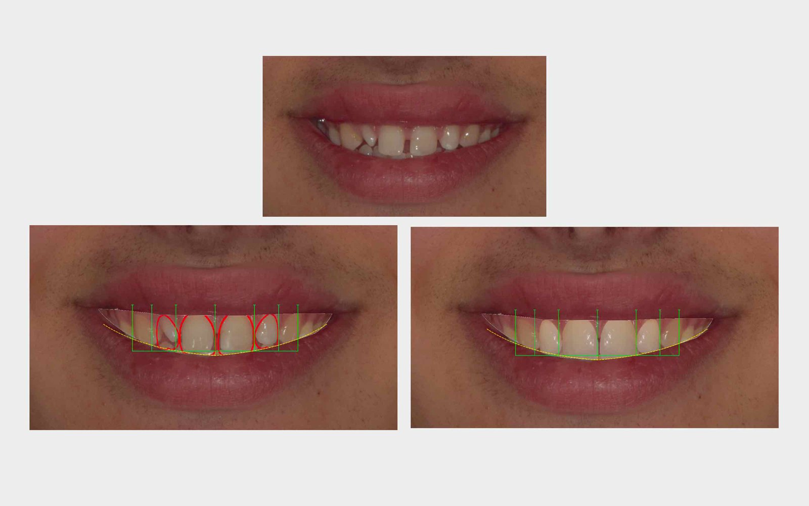Simulazione digitale del sorriso prima e dopo il trattamento