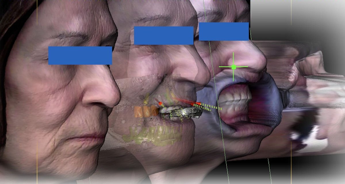 Elaborazione tridimensionale del volto per la progettazione del sorriso