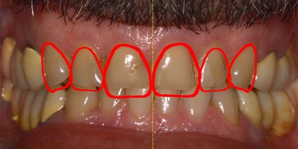 faccette dentali