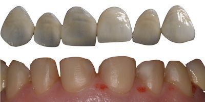 faccette dentali
