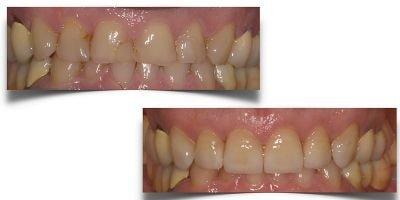 faccette dentali