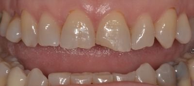 faccette dentali