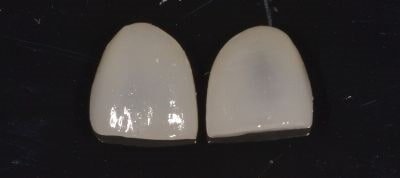 faccette dentali